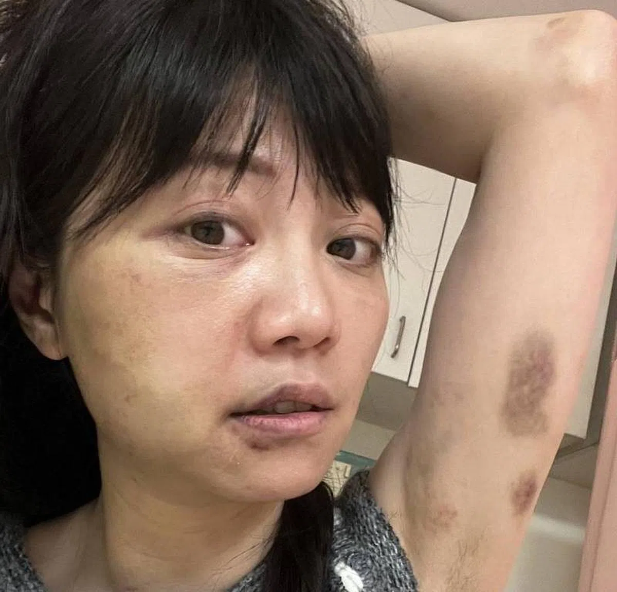 高嘉瑜遭家暴伤势照片曝光。(高嘉瑜办公室)