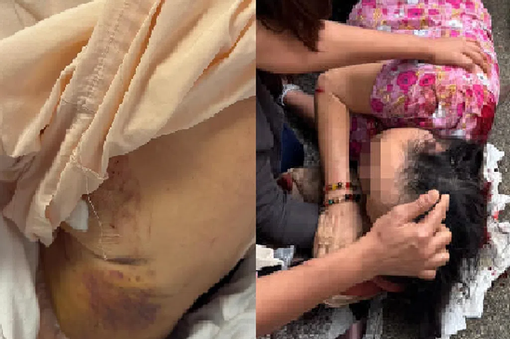 树干砸伤妇女 律师：可提民事诉讼追责