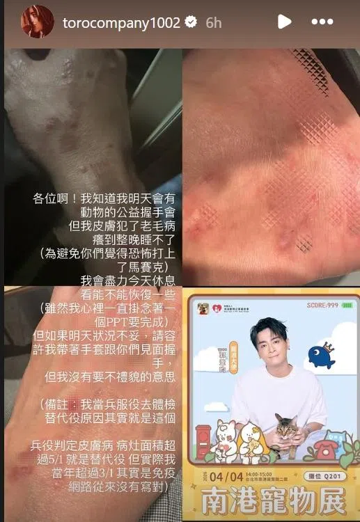 Toro贴出皮肤多处红肿的照片，（Toro IG截图）