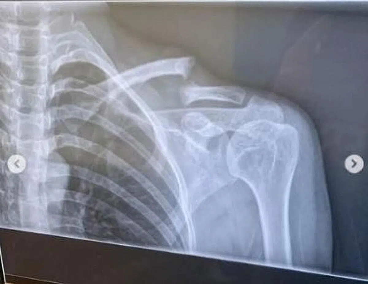 赵彩聆锁骨骨折需动手术。（图：艺人IG）