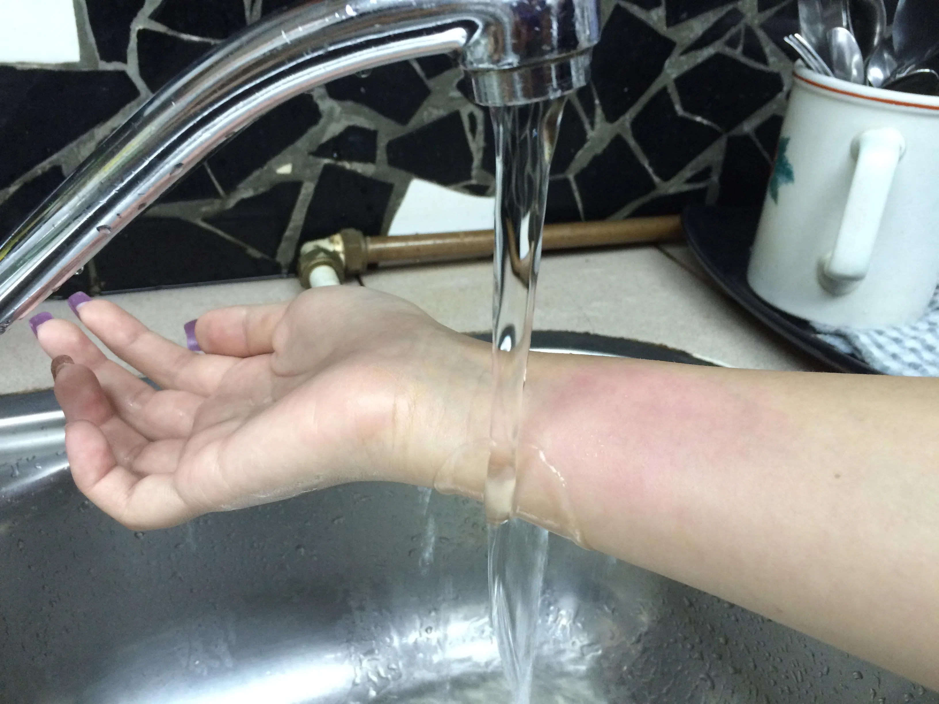 一旦被烫伤或烧伤，应马上让烫伤部位在水龙头下冲流至少20分钟，迅速降低部位的温度。（档案照片）