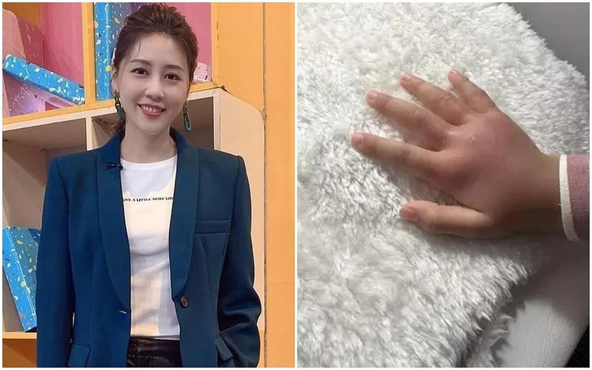 严立婷心疼女儿的手被蚊子咬到红肿。（互联网）