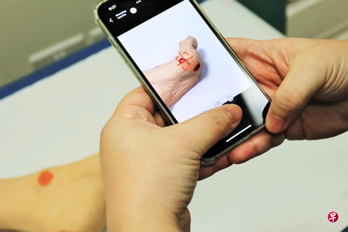 樟宜综合医院推出AI伤口护理应用助护士精准评估伤口| 联合早报