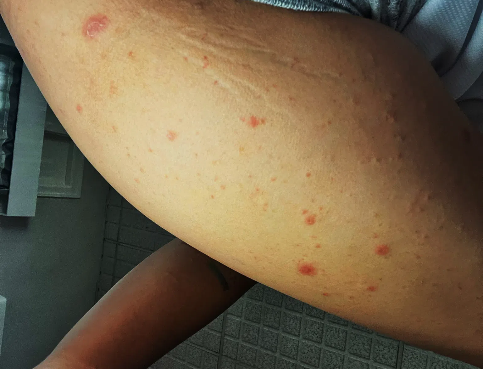 被臭虫叮咬后，大部分人会出现瘙痒和红肿的症状。（Ironman Pest Control提供）