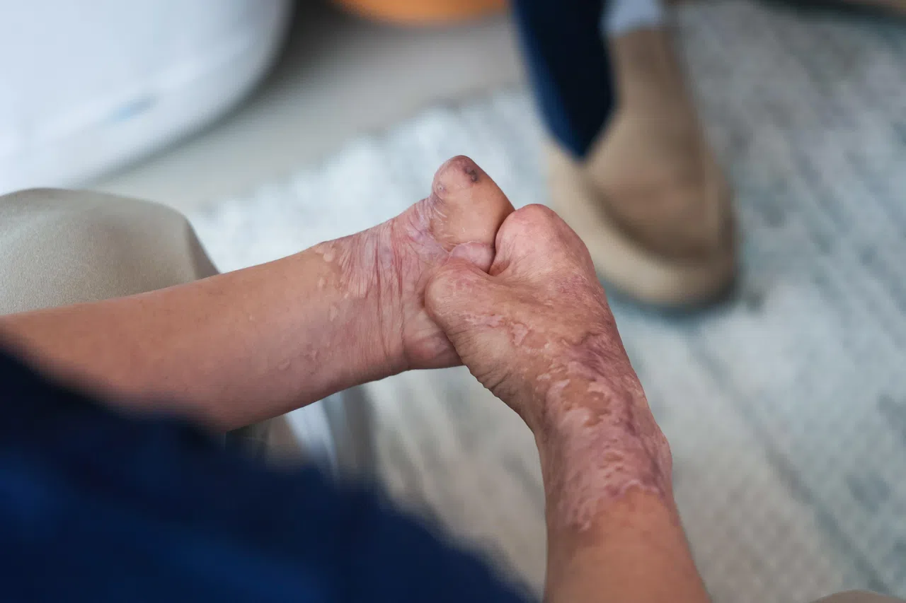 陈博盛的肺部感染导致四肢坏疽，须截肢。（张俊杰摄）