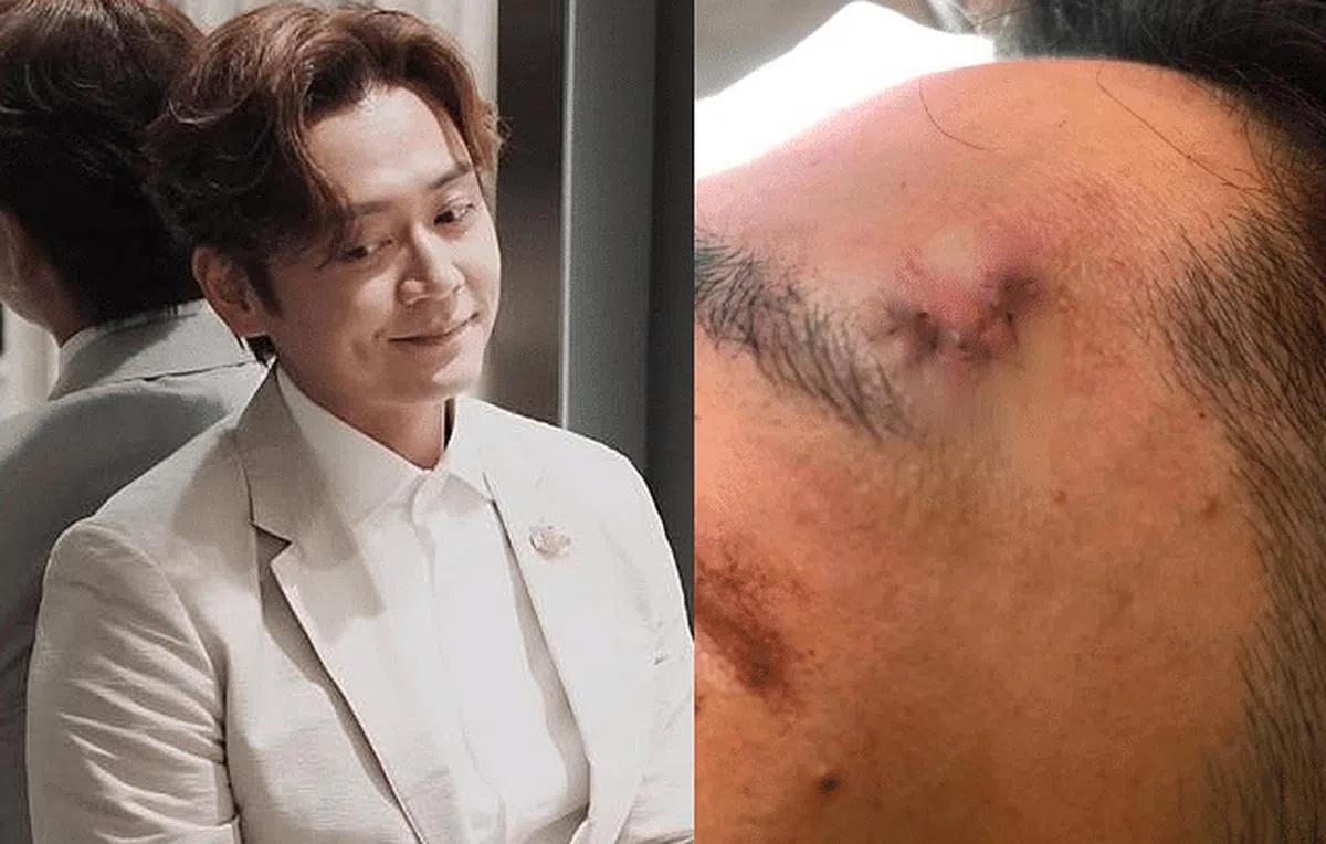 无线演员张振朗拍戏受伤左眉骨缝了七针。（互联网）