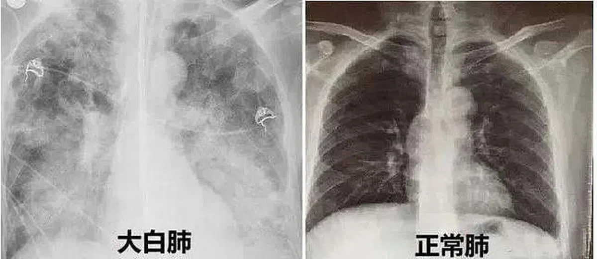 中国互联网流传的照片显示，左图为“大白肺”，右图是正常的肺部。（互联网）