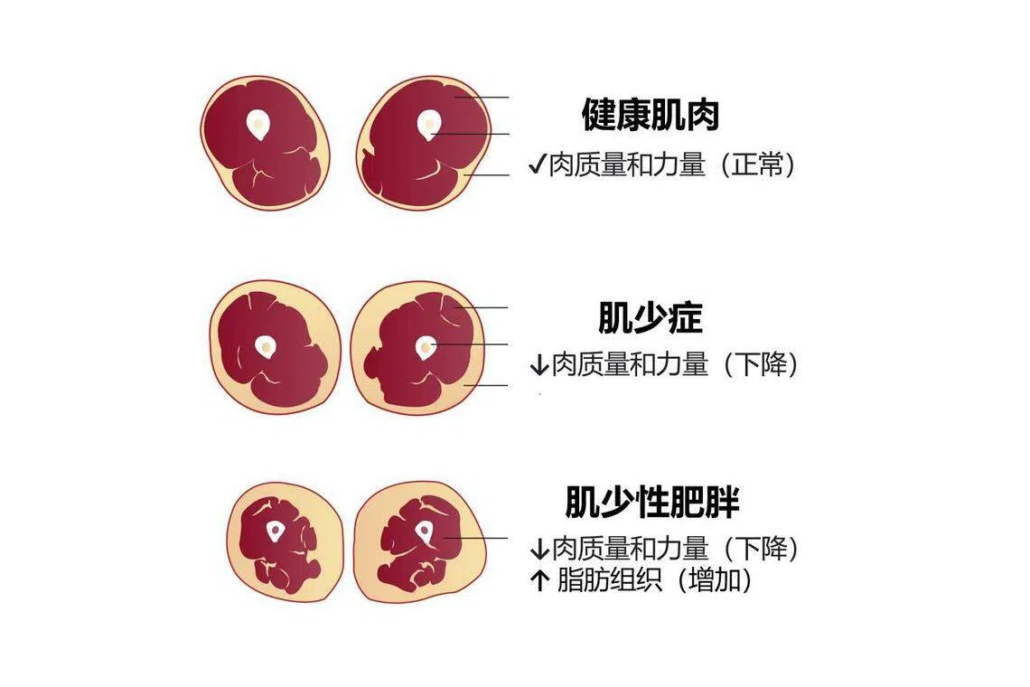 腹部肥胖会导致肌少性肥胖，肌肉减少性肥胖与肌间脂肪组织有关。