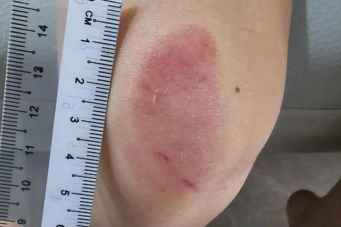 女童的左膝盖、嘴唇、右手肘和手指都有明显擦伤，膝盖伤口有四公分长。（受访者提供）