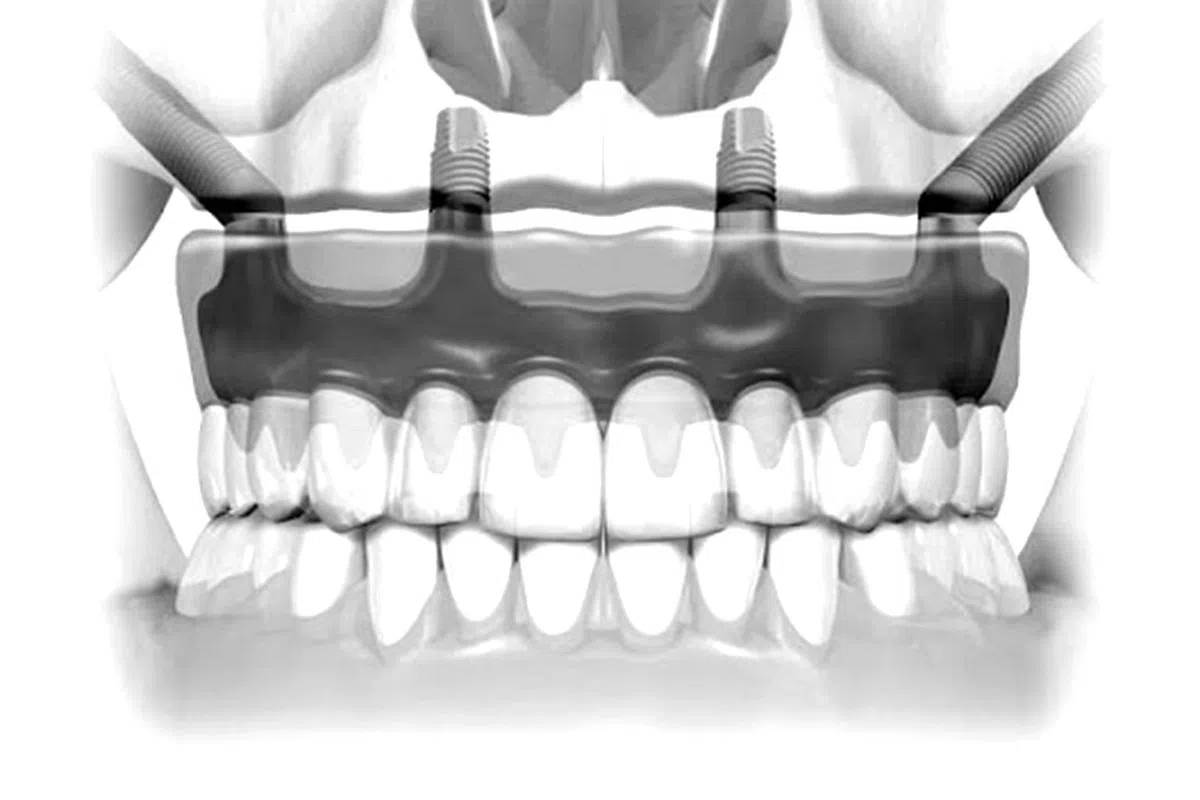 植牙手术的安全性和精确度至关重要。（图/T32牙科中心提供）
