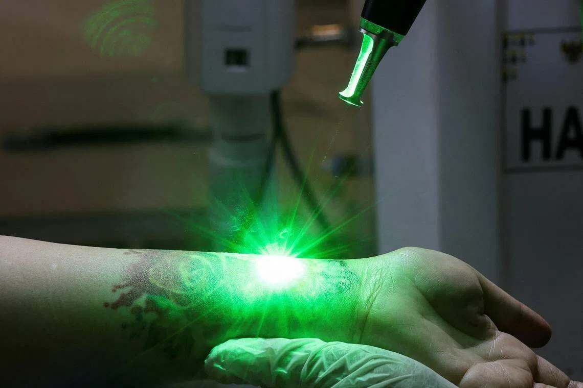 3月26日，一名印尼女子在斋戒月免费去除文身的活动中接受激光去除手术。（路透社）