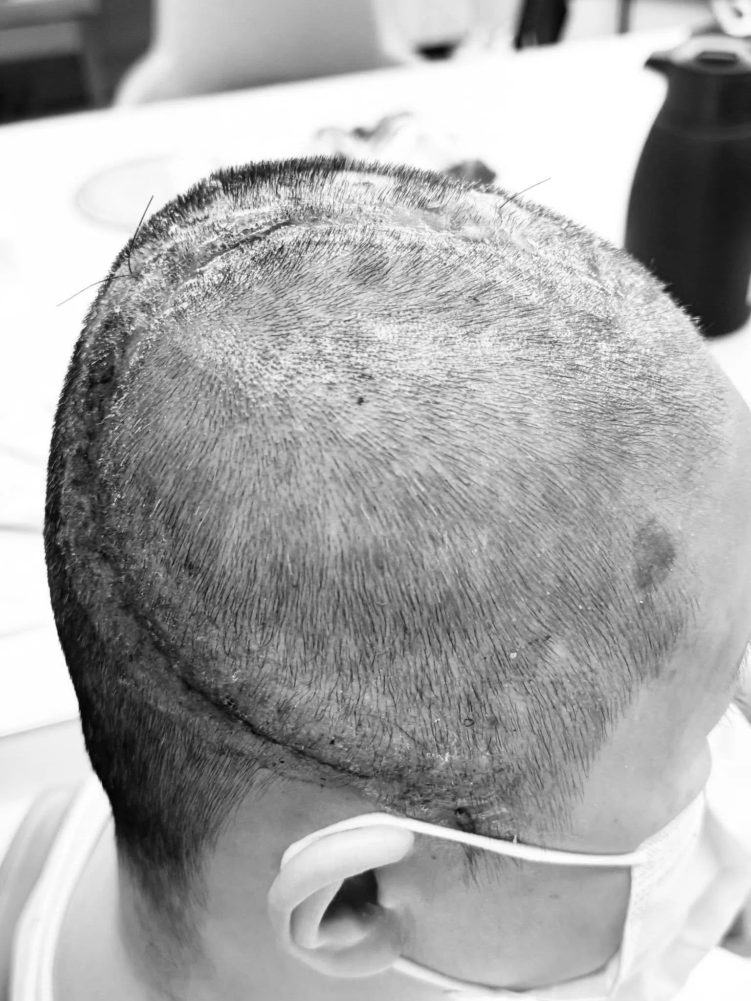 王月分享手术伤疤。（取自王月脸书）