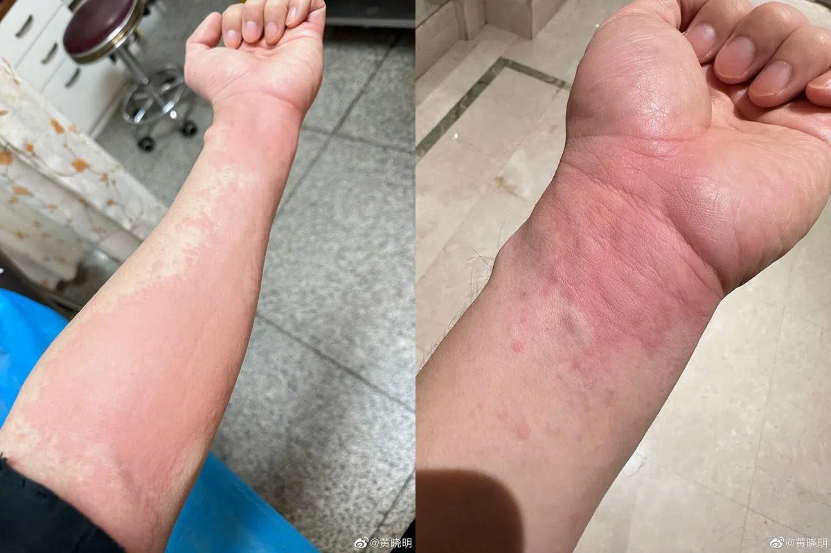 除了肠胃炎，黄晓明还得了急性荨麻疹。（取自艺人微博）